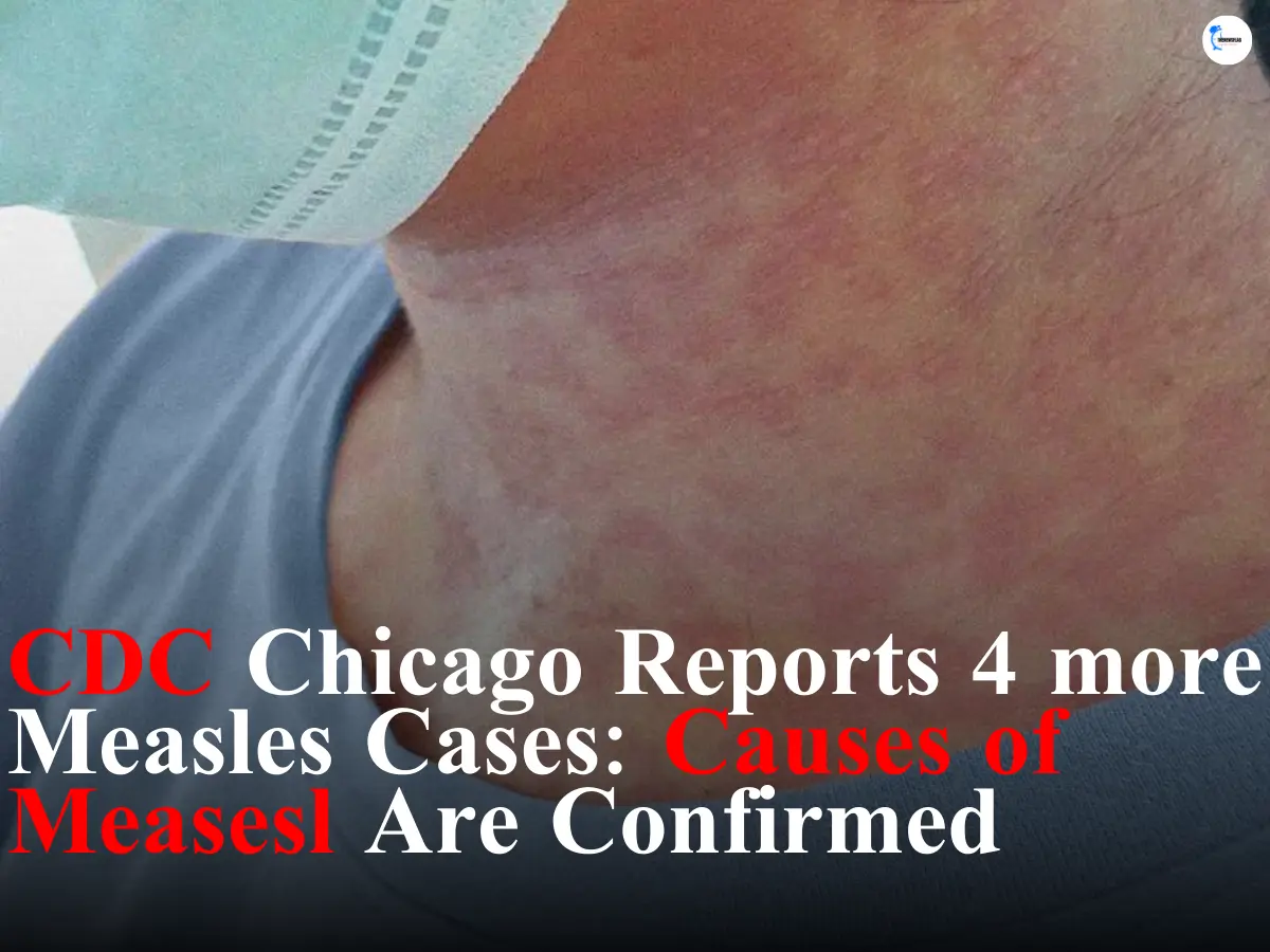 CDC Chicago Reports 4 more Measles Cases