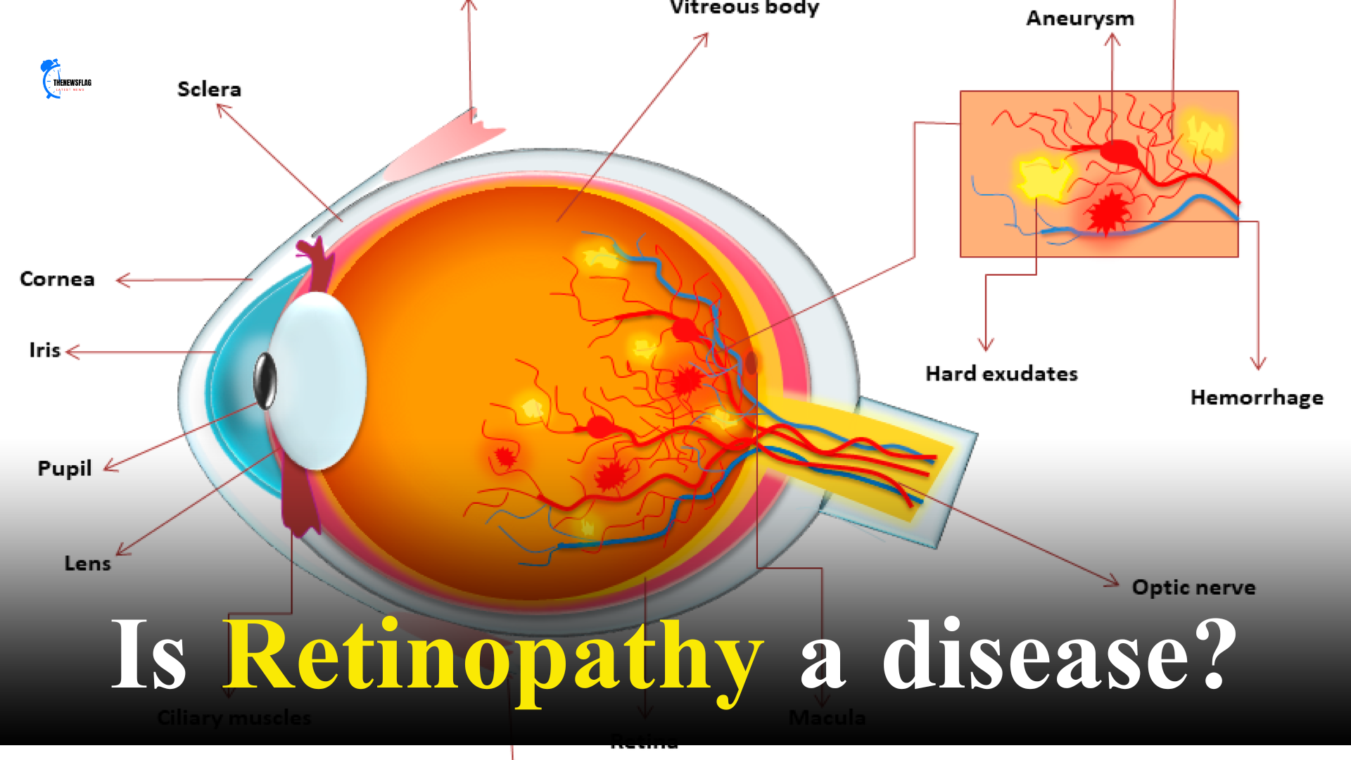Is Retinopathy a disease?